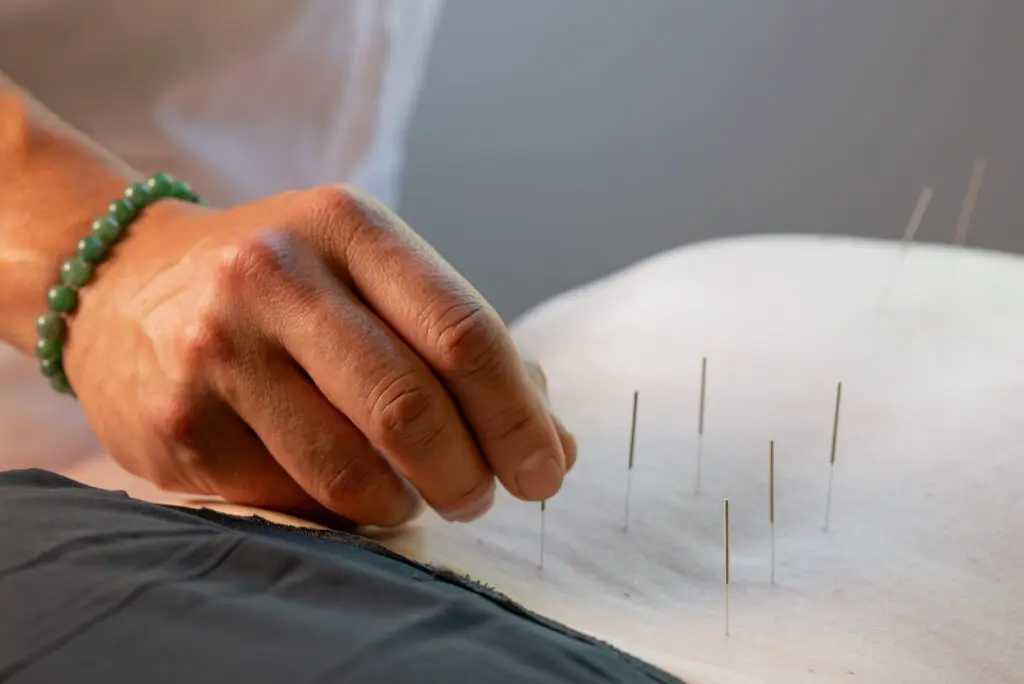 Acupuncture treatment close-up