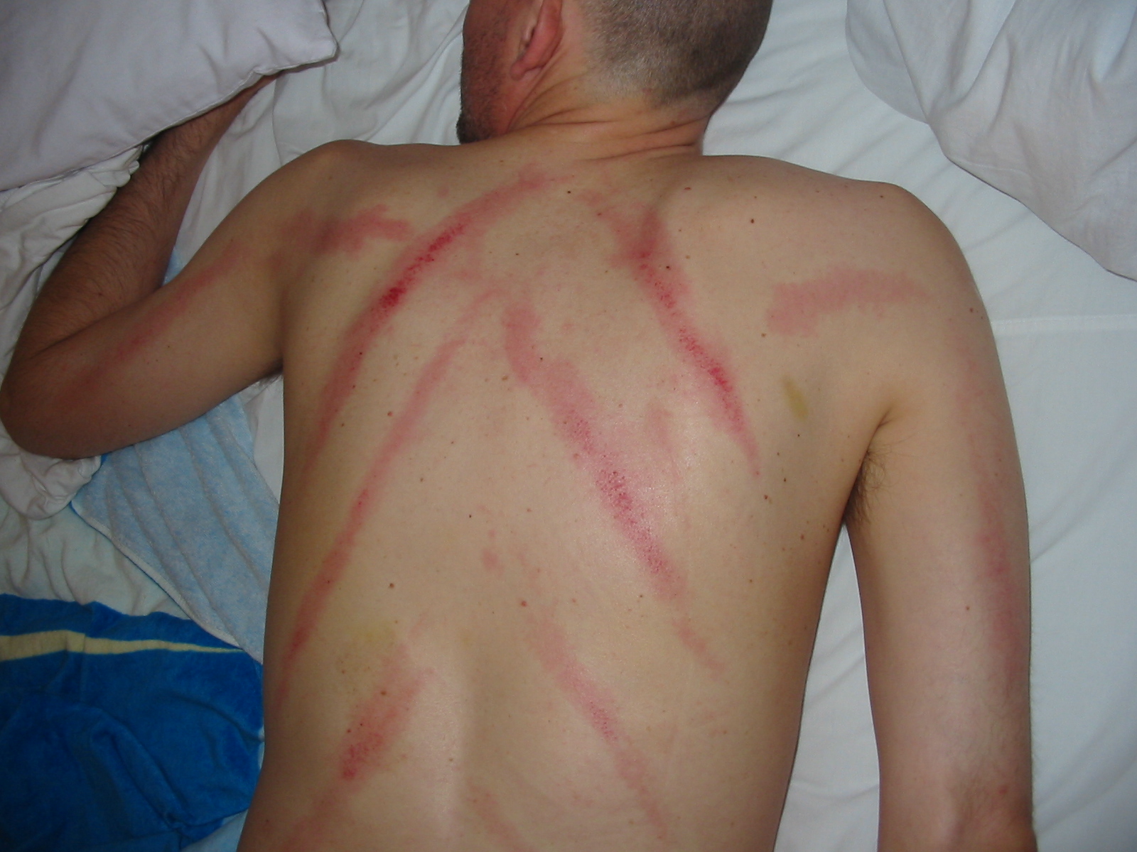 Temporary red streaks on a patient's upper back after gua sha treatment.